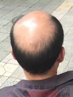 禿頂寸頭效果圖 看看禿頂是什麼樣子的